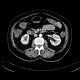 Diverticulum of duodenum: CT - Computed tomography